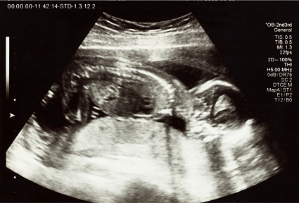 Black and white sonogram of a foetus